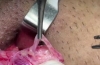 精索静脉曲张 - 显微外科精索静脉曲张切除术
