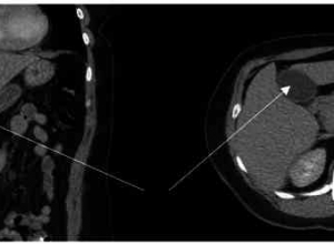 游走性胆囊：镰状韧带急性胆囊炎罕见病例