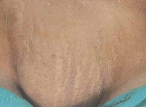 女性腹股沟疝中两个斜疝囊和一个Nuck管：病例报告