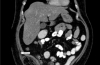 腹腔镜修补大型嵌顿性腹股沟疝（类似急性阑尾炎）：病例报告