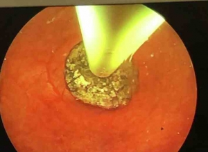 对部分有症状胆结石患者行保留胆囊的胆囊切开取石术：病例系列研究