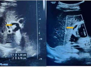 双胆囊：病例报告及文献综述