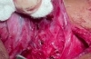 甲状腺叶切除术 + 峡部切除术治疗滤泡性肿瘤