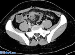 原发性腹膜炎：一例神秘病例及文献探索——诊断挑战和治疗方法（病例报告）
