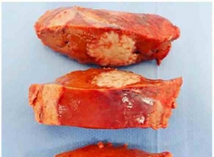 腹腔镜下肝脏第8段亚段切除术和胆囊切除术诊断原发性肝胆非霍奇金淋巴瘤：一例罕见病
