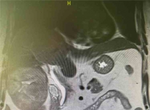 腹腔镜解剖性肝切除术的方法：是否都适用？