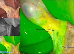 吲哚菁绿荧光透视在腹腔镜胆囊切除术中胆管可视化的作用：一项针对 70 例患者的观察性