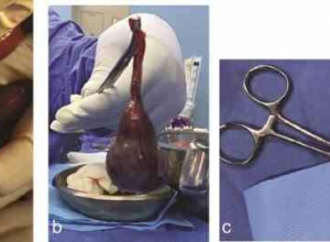 阑尾黏液囊肿的诊断和治疗：一种罕见的肠梗阻病因