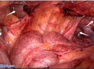 同一患者同时出现多发性双侧腹股沟疝；病例报告及罕见腹股沟疝回顾：成功修复后持续疼