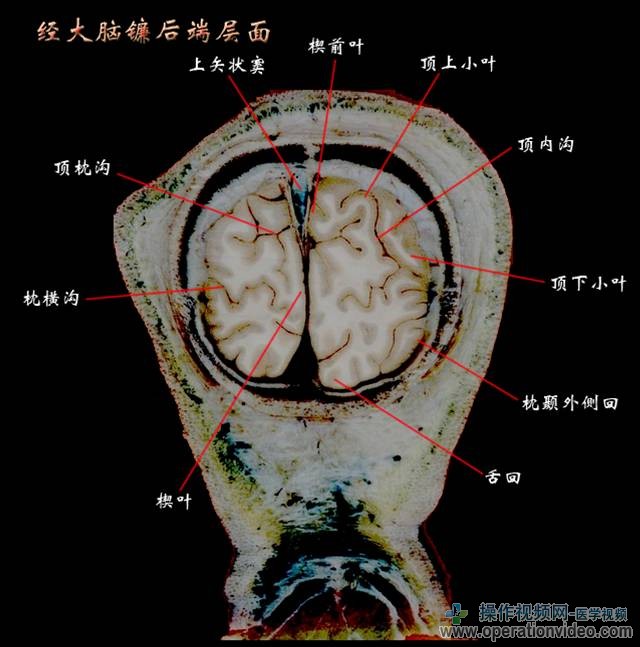 经大脑镰后端层面.jpg