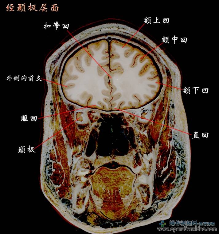 经颞极层面.jpg