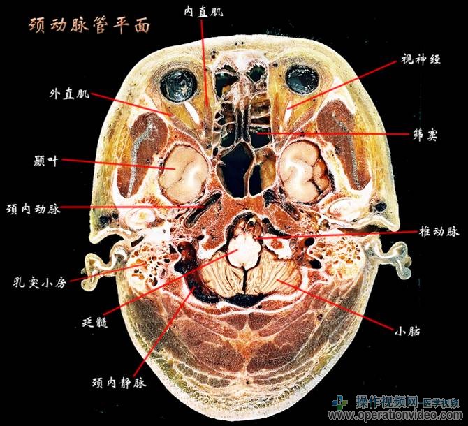 颈动脉管平面.jpg