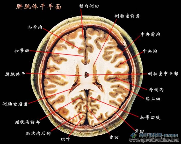 胼胝体干平面.jpg