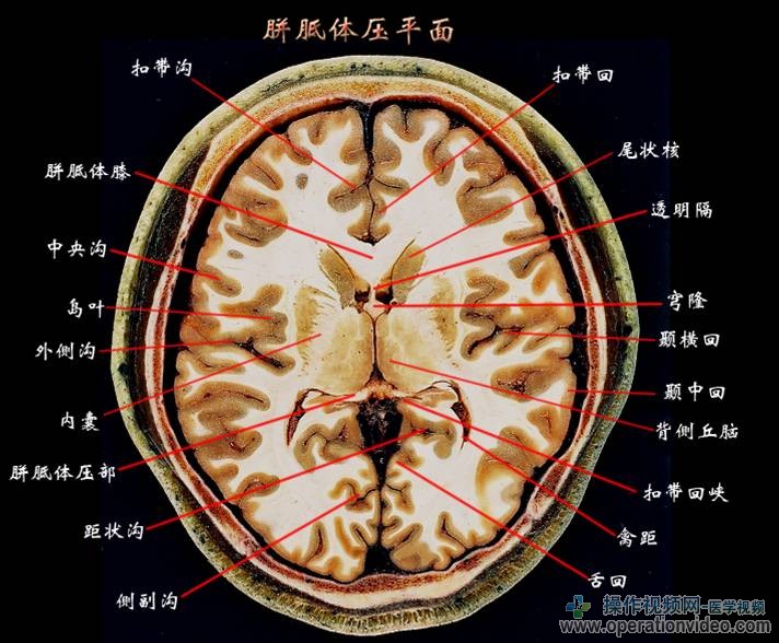 胼胝体压平面.jpg