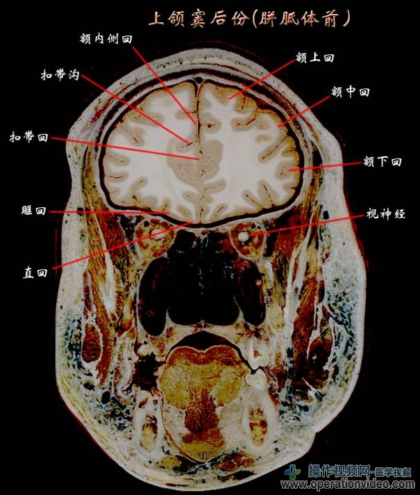上颌窦后份(胼胝体前).jpg
