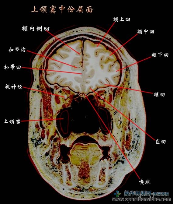 上颌窦中份层面.jpg