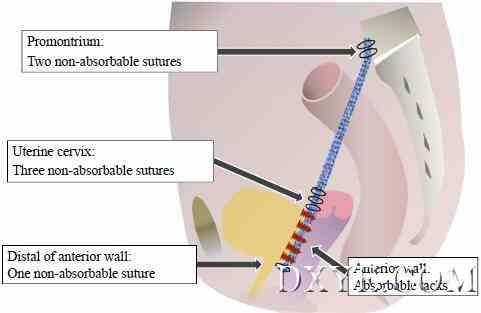 如何减少腹腔镜骶骨阴道固定术手术时间？