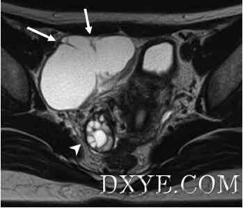 Isolated fallopian tube torsion diagnosed and treated with laparoscopic surgery- A case report