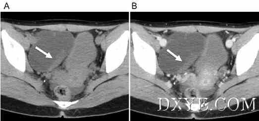 Isolated fallopian tube torsion diagnosed and treated with laparoscopic surgery- A case report