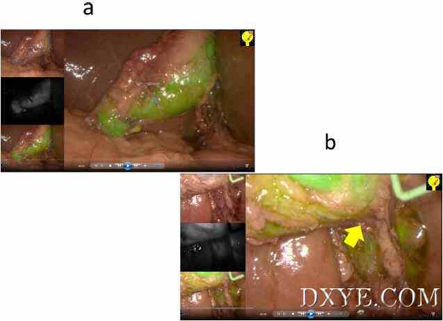 使用精确内镜荧光成像系统与术中荧光成像的腹腔镜胆囊切除术一例报告