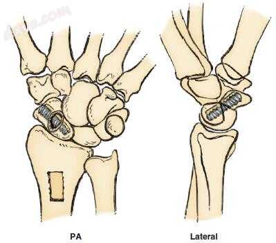 手外科的手术操作解读:60-16 腕骨骨折「图解」 - 骨科（手外、四肢脊柱 