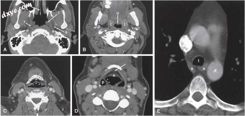 耳鼻咽喉-头颈外科「图解」206-101-咽食管诊断性影像学- 耳鼻咽喉头颈 