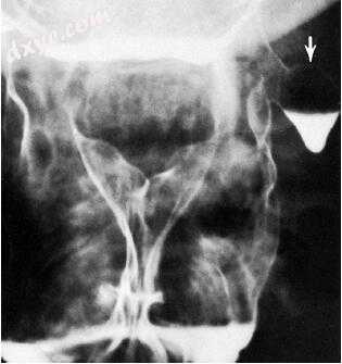 耳鼻咽喉-头颈外科「图解」206-101-咽食管诊断性影像学- 耳鼻咽喉头颈 