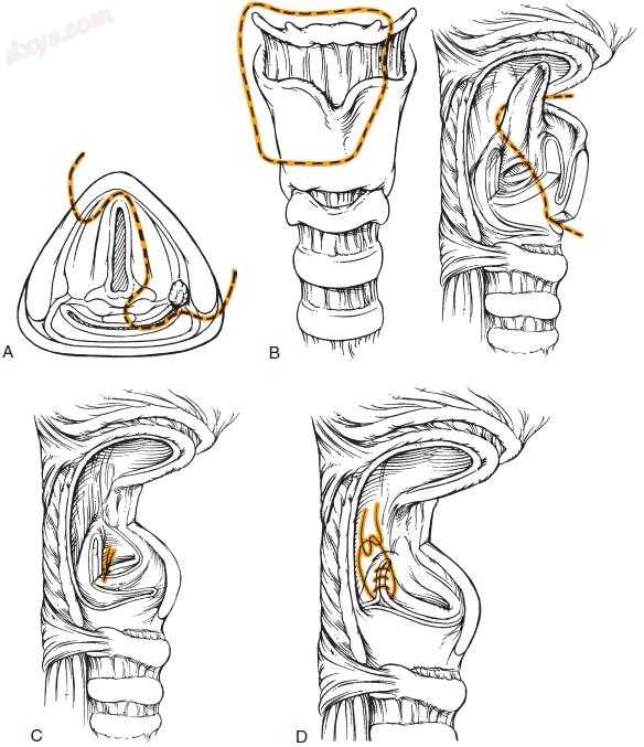 耳鼻咽喉-头颈外科「图解」206-102-下咽及颈段食管肿瘤- 耳鼻咽喉头颈 