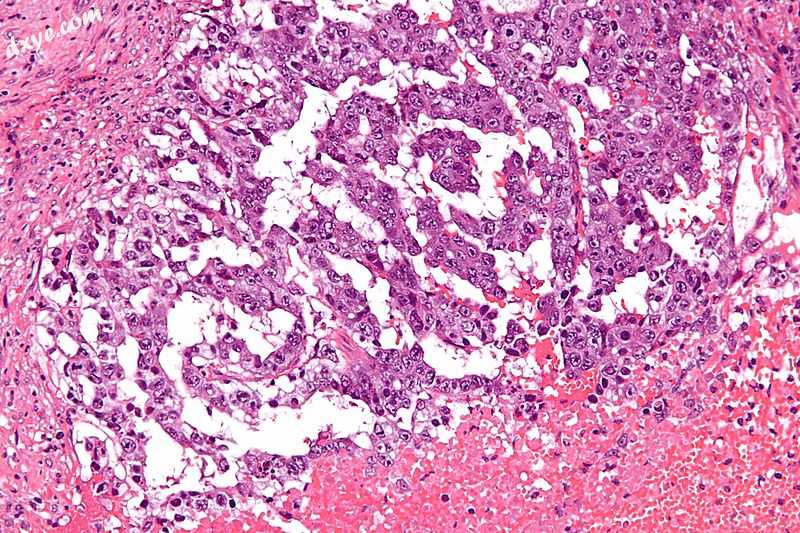 Micrograph showing the yolk sac component of a mixed germ cell tumour. H&amp;E stain..jpg