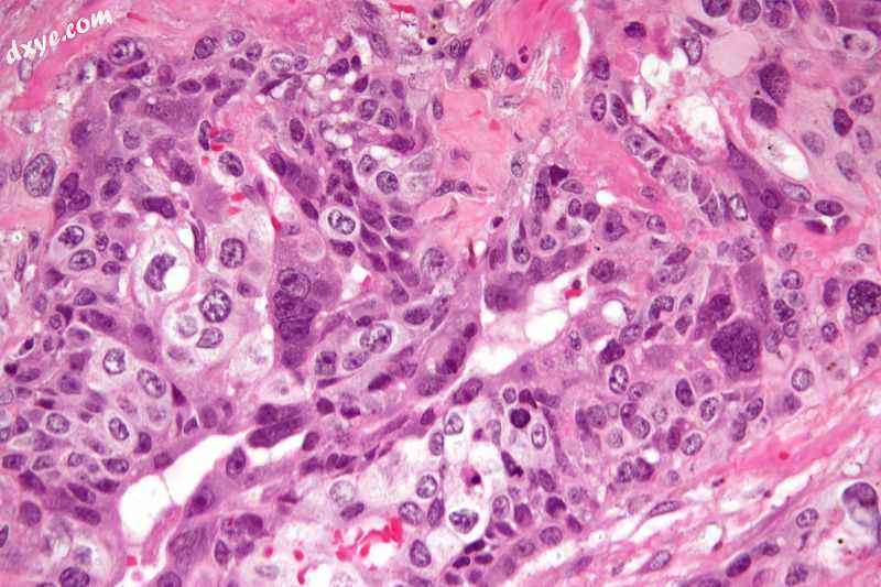 Micrograph of choriocarcinoma showing both of the components.jpg