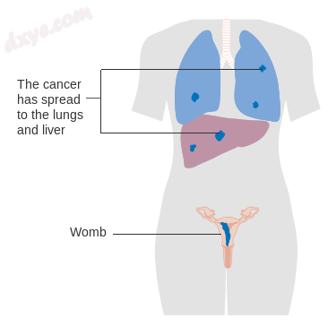 Stage 4 choriocarcinoma.png