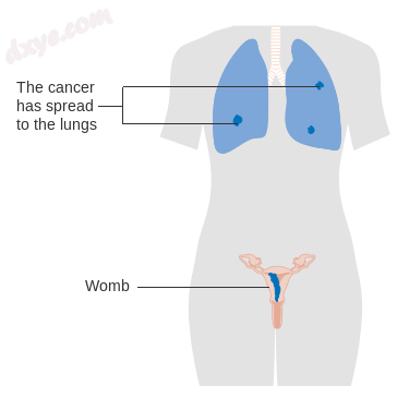 Stage 3 choriocarcinoma.png