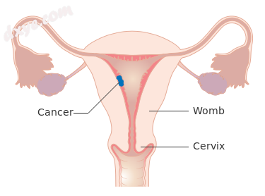 Stage I choriocarcinoma.png