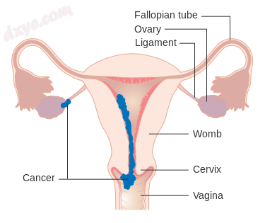 Stage 2 choriocarcinoma.png