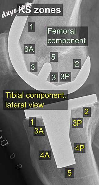 KS (Knee Society) zones, lateral view.[23].jpg