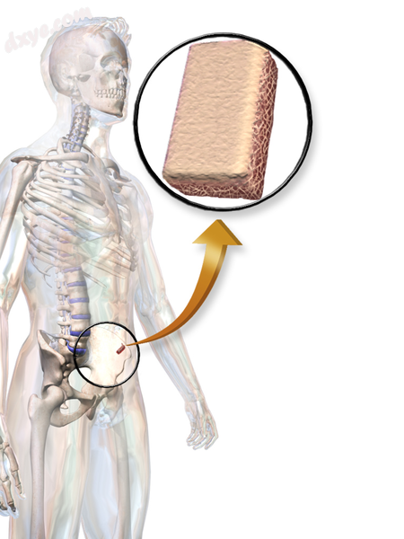 Illustration depicting bone autograft..png