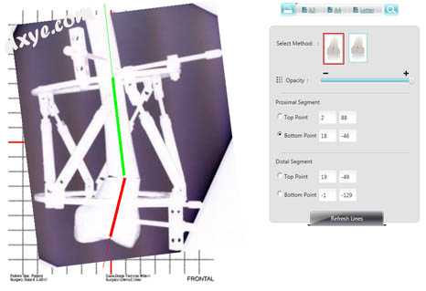 Radiographic imaging is combined with computer technology to reduce a distal fem.jpg