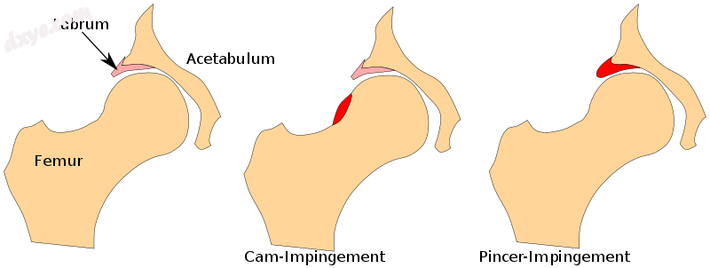 Diagram illustrating the two subtypes of FAI..png