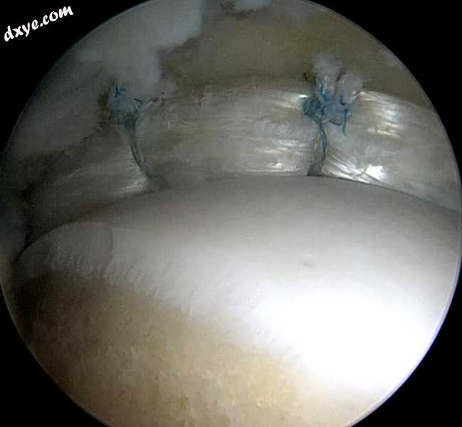 Arthroscopic view of the superior acetabular labrum hopaedics and Sports Medicine..jpg