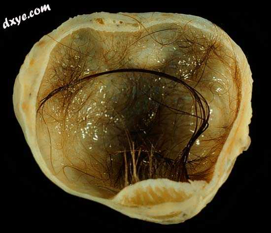 A cystic 畸胎瘤 with a small Rokitansky结节 — region of thickened cyst wal.jpg