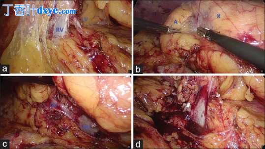 肾部分切除术中肾静脉损伤的腹腔镜处理