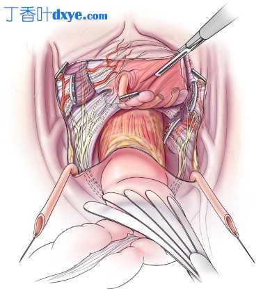 腹腔镜根治性膀胱切除术