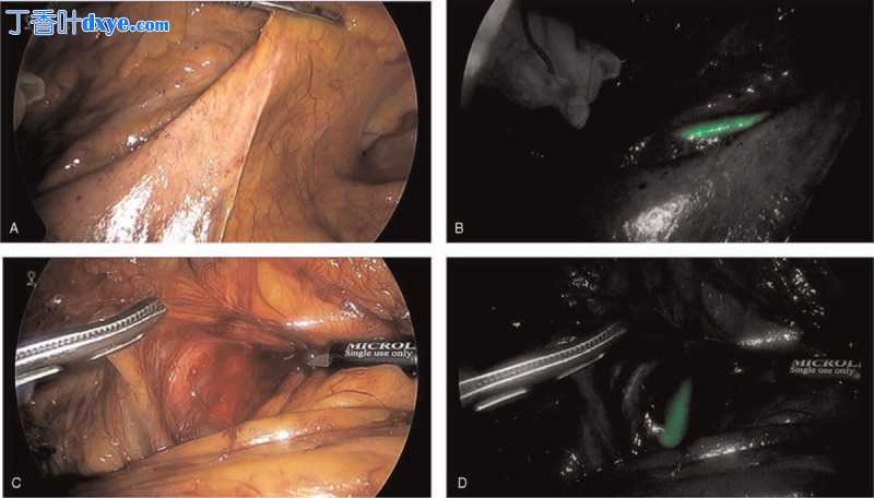 腹腔镜乙状结肠切除术治疗严重憩室病和荧光输尿管识别