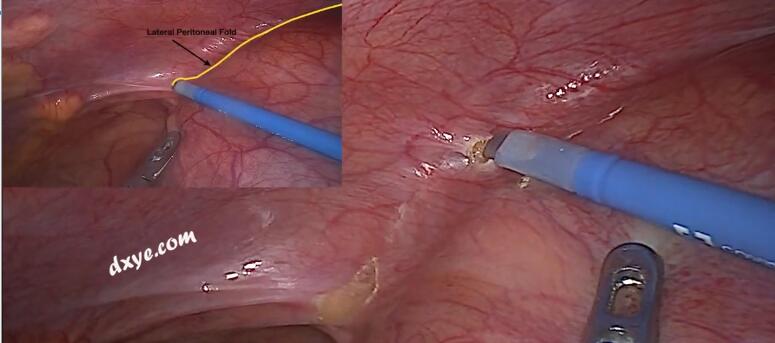 使用关节装置进行腹腔镜大型囊性盆腔肿块切除术