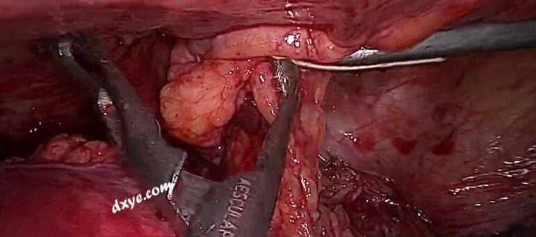 使用关节装置进行腹腔镜大型囊性盆腔肿块切除术
