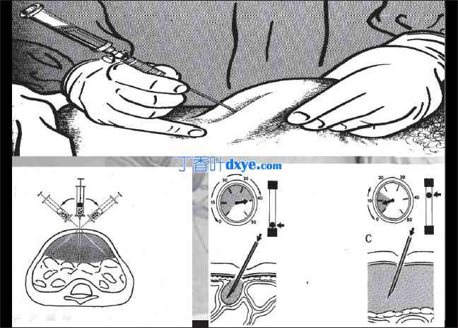 腹腔镜手术入路并发症