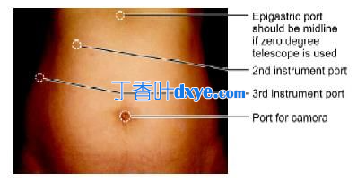 腹腔镜端口定位原则