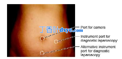 腹腔镜端口定位原则