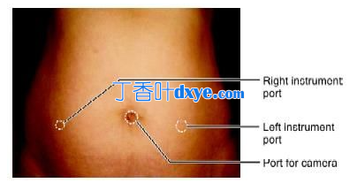 腹腔镜端口定位原则