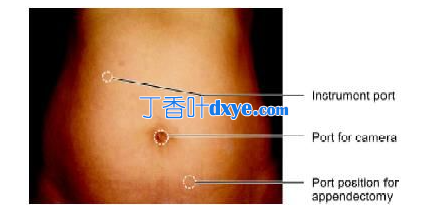 腹腔镜端口定位原则